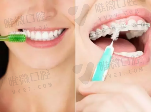 牙齿贴面是什么原理（牙齿贴面步骤全过程）(图1)